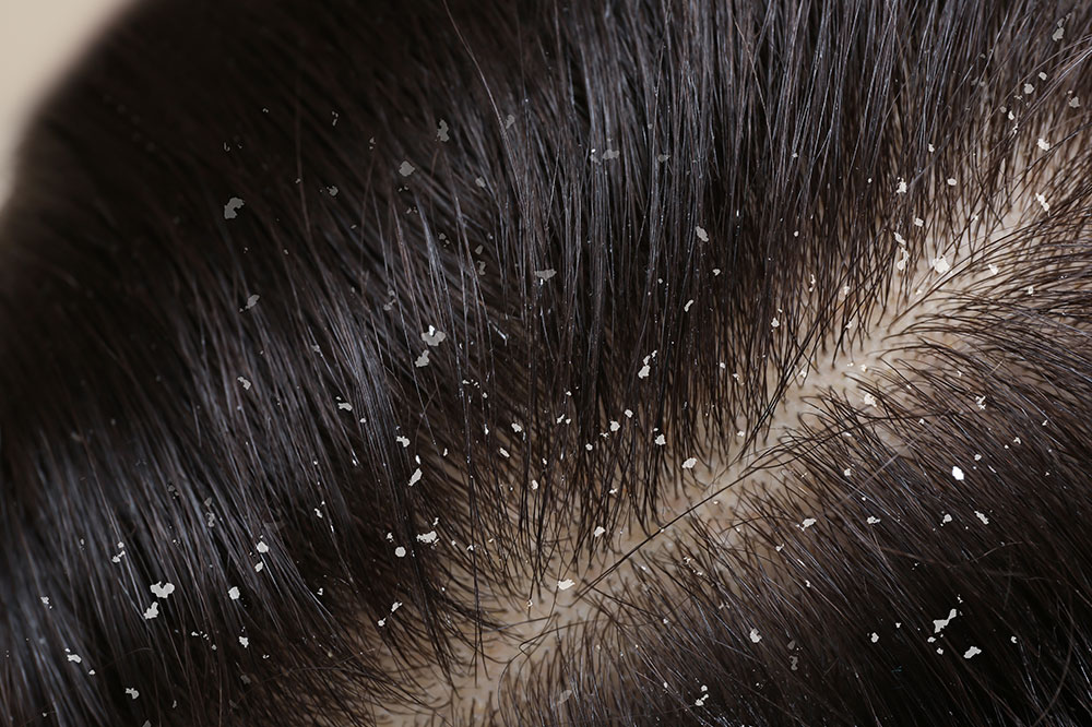 5 Foods to Avoid to Banish Dandruff and Flakes