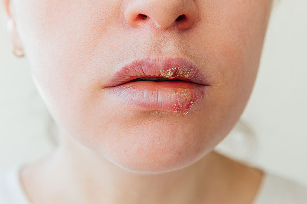 8 Effective Home Remedies for Cold Sores