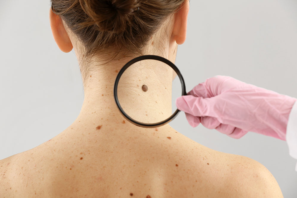 Melanoma – Diagnosis and Treatment