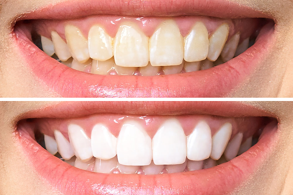 The Cost and Process of Popular Teeth-Whitening Procedures